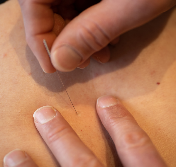 dry needling